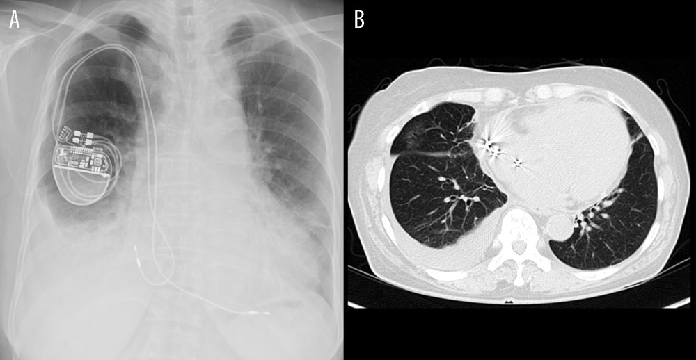 (A) Chest X-ray and (B) computed tomography showing massive right pleural effusion.