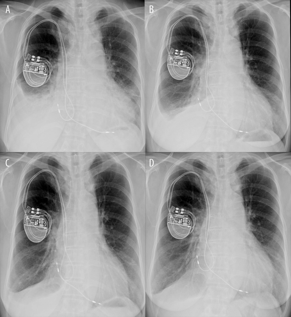 Serial chest X-ray findings of right pleural effusion. (A) Chest X-ray reveals massive right pleural effusion after pleural puncture test. (B) Chest X-ray after 1 month of anti-inflammatory drug combined with a short period of diuretics. Right pleural effusion persisted. (C) Chest X-ray after 2 months of taking anti-inflammatory drug in combination with diuretics for a short period. Right side costophrenic angle was still apparently dull. (D) One month after using Saireito. Right costophrenic angle is sharp, indicating that right pleural effusion is completely resolved.