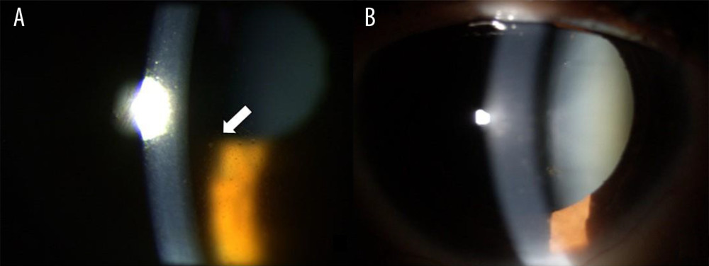 Acute anterior uveitis: (A) Tyndall effect (arrow) before treatment. (B) Absence of the Tyndall effect after 12 months of treatment.