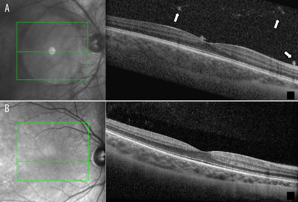 Acute anterior uveitis: (A) Spectral domain optical coherence tomography showed normal macular thickness, no retinal pigment epithelium dystrophy, and cell flow (arrow) in the vitreal camera before treatment. (B) After 12 months of treatment, there were no vitreal alterations and macular thickness remained within the normal range.