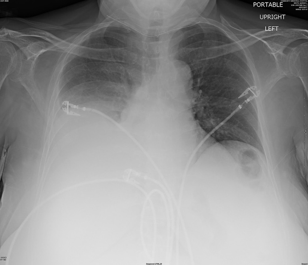 Chest X-ray showed an elevation of the right hemidiaphragm with right base atelectasis and moderate right pleural effusion.