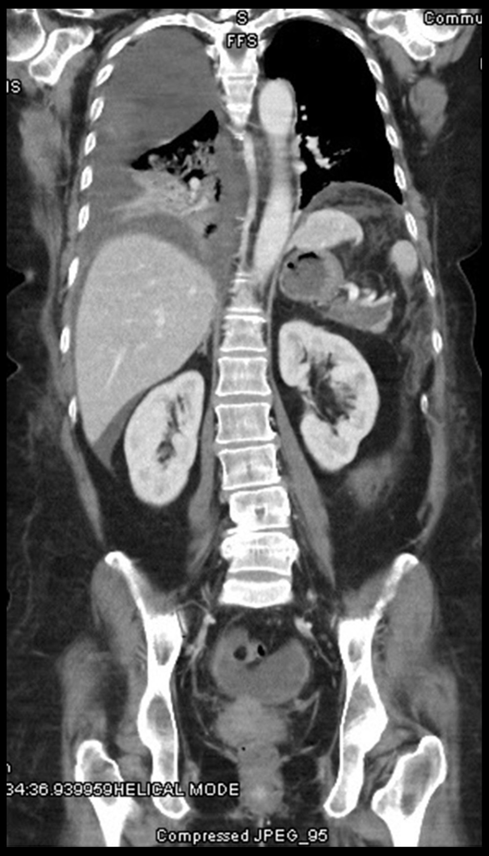 Coronal computed tomography scan of the chest and abdomen showed loculated moderate right pleural effusion and a small left pleural effusion with an associated right middle-lobe and right lower-lobe atelectasis and consolidation.