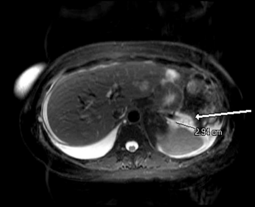 Magnetic resonance cholangiopancreatography: 3.9×1.8 cm fluid collection seen near the pancreatic tail.