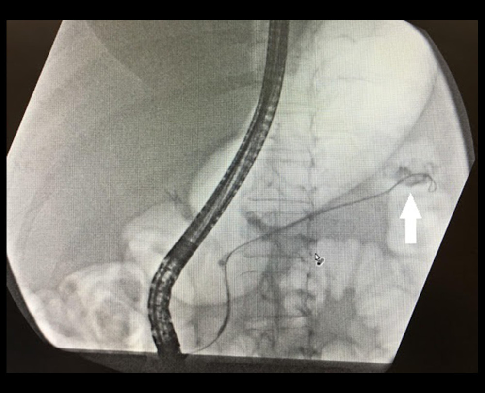Endoscopic retrograde cholangiopancreatography with contrast extravasation at the distal tail of the pancreas and into the peritoneal cavity.