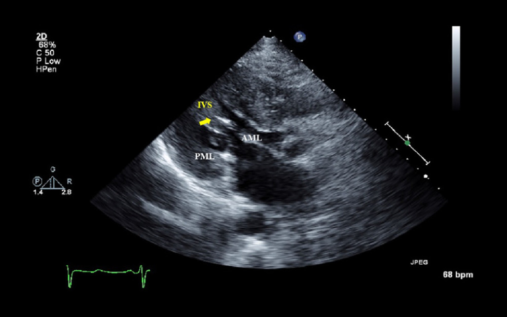 Transthoracic echocardiogram at admission (2014). Parasternal long-axis view. The motion of the anterior mitral leaflet toward the interventricular septum during systole (yellow arrow).