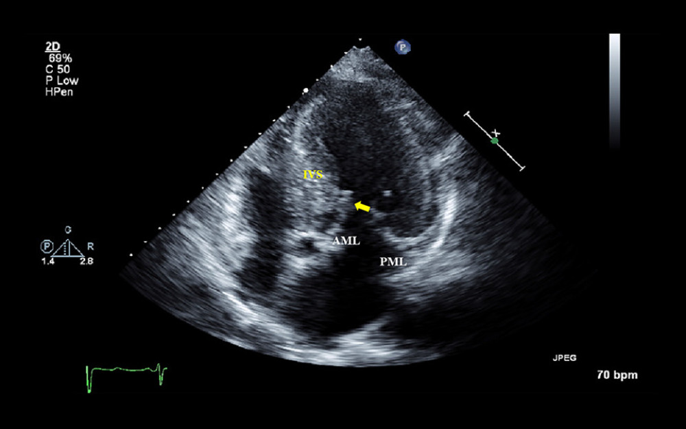 Transthoracic echocardiogram at admission (2014). 4-chambers view. The motion of the anterior mitral leaflet toward the interventricular septum during systole (yellow arrow).