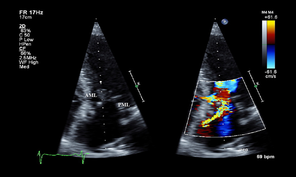 Transthoracic echocardiogram at admission (2014). 4-chambers view. The anteriorly directed jet of mitral regurgitation (right figure).