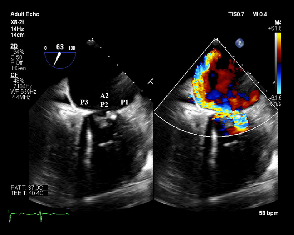 Transthoracic echocardiogram in 2020. Mid-esophageal commissural view. The anteriorly directed jet of mitral regurgitation.