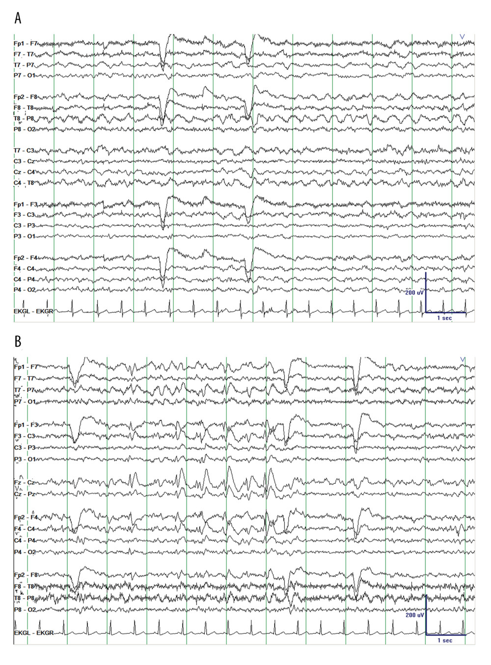 Electroencephalography (longitudinal bipolar montage, sensitivity 10 μV/mm) on presentation demonstrating (A) mild diffuse background slowing with (B) occasional bifronto-centrally predominant sharp and spike wave discharges, frequently occurring in (very) brief runs without ictal evolution and primarily observed in wakefulness and N1 sleep.