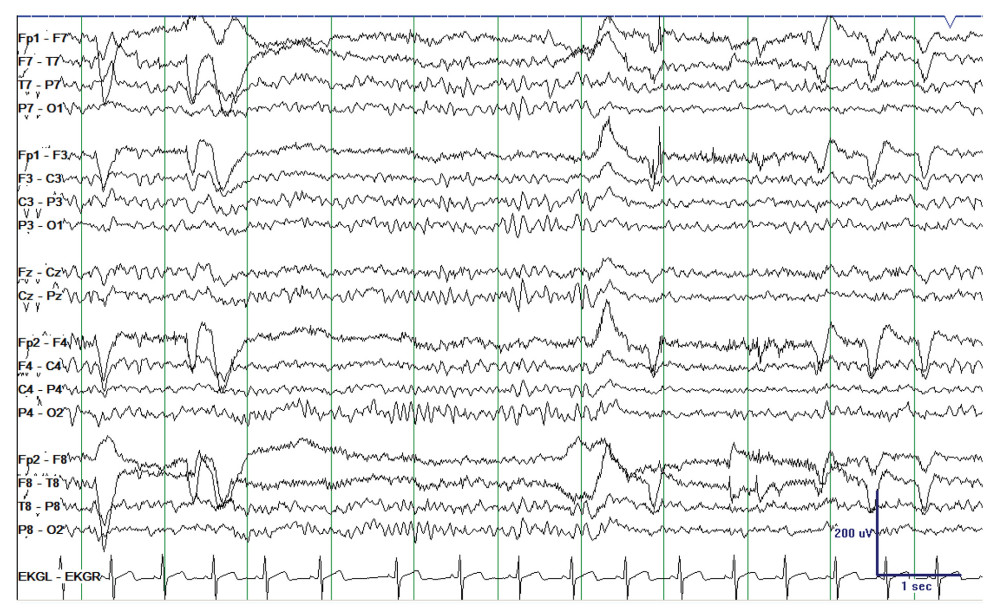 Repeat electroencephalography 7 days after presentation demonstrating normalization of the background.