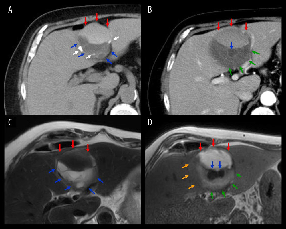 Hepatic CT and MRI findings. (A, B) Imaging findings of plain CT (A) and T2-weighted MRI (B). Calcifications were clearly detected on plain CT (white arrows). The multilocular cyst (ie, cyst-in-cyst) contained mucus (blue arrows). A hematoma was observed inside (red arrows). (C, D) Imaging findings of dynamic CT (C) and T1-weighted MRI (D). The cystic, mucus-producing tumor contained not only mucus (blue arrows), but also muddy-looking fluid (ie, inspissated bile) (green arrows) and hematoma (red arrows). The cyst wall did not show enhancement, and a partial solid component was observed (orange arrows). CT – computed tomography; MRI – magnetic resonance imaging.
