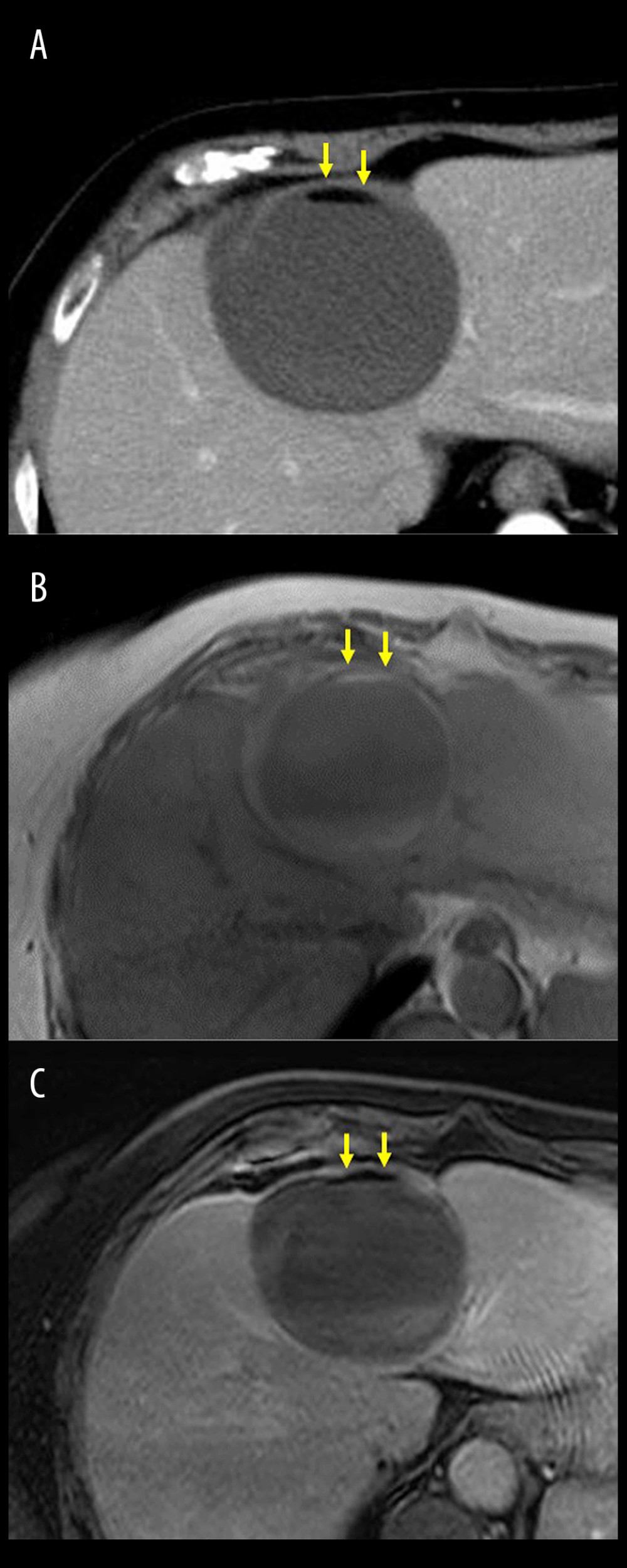Fatty tissue within the cyst. Imaging findings of plain CT (A), T1-weighted MRI (B), and fat-suppressed MRI (C). The cystic, mucus-producing tumor clearly included fatty tissue (yellow arrows). CT – computed tomography; MRI – magnetic resonance imaging.