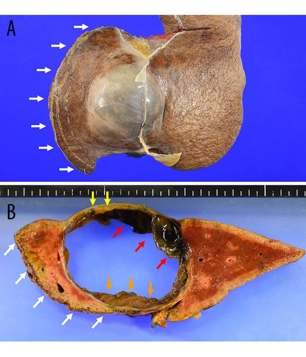 Gross pathological examination. Examination of the resected specimen revealed that the tumor was 10.5 cm and was curatively removed without any rupture of the cyst (overhead view, A). The cyst was multilocular, with mucus, calcifications, hematoma (red arrows), and fatty tissue (yellow arrows) observed (coronary view, B). Inspissated bile was present within the tumor. Cut surface (white arrows) is presented (A, B).