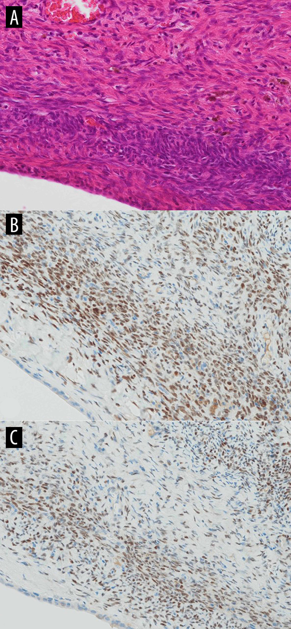 Ovarian-like stroma. Ovarian-like stroma was observed (hematoxylin-eosin staining, ×80 magnification) (A). Ovarian-like stroma was positive for estrogen receptor (B) and progesterone receptor (C) in immunohistochemical studies.