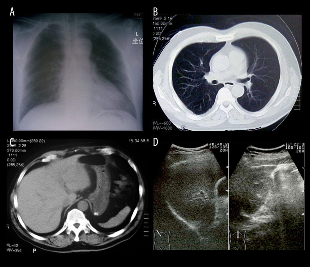 Imaging studies of the chest and abdomen. (A) Chest radiography. (B) Computed tomography (CT) image of the chest. (C) CT of the abdomen. (D) Abdominal ultrasonography image. There were no remarkable findings.