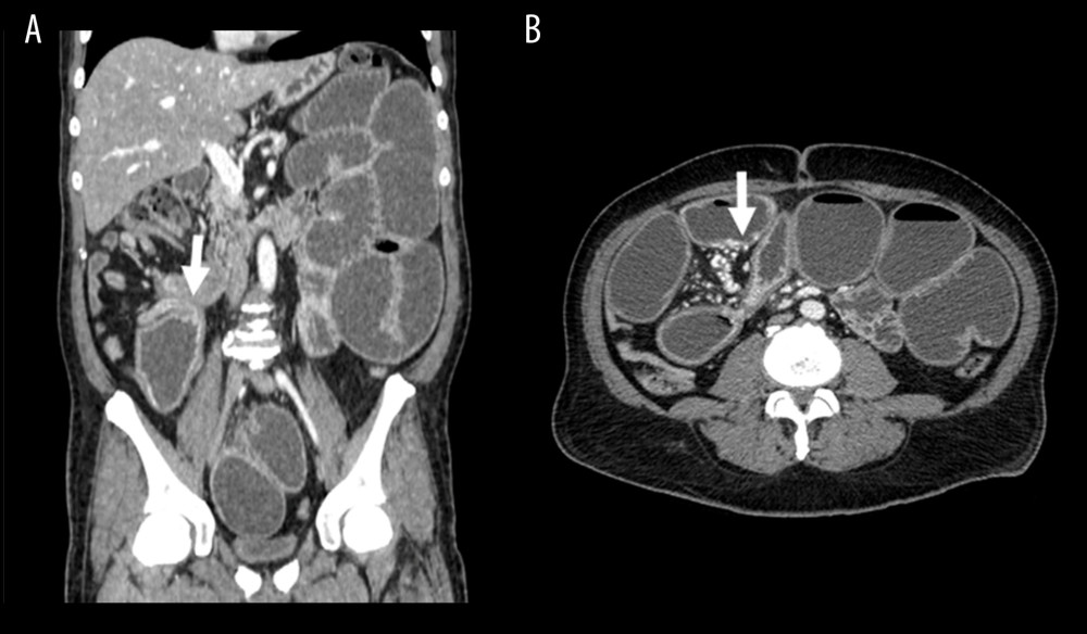 (A) Computed tomography (CT) examination with contrast medium. Coronal reformat shows a large mass in the mesenteric fat is demonstrated at the site of the obstruction on the right side, and the mass causes the change of bowel caliber (arrow). The mass is well-defined, spiculated, and hyperattenuating, compared with the adjacent mesenteric fat, and slightly inhomogeneous with some calcifications. (B) Computed tomography (CT) examination with contrast medium. Axial reformat in the portal venous phase demonstrates signs of small bowel obstruction with multiple dilated bowel loops. The mesenteric mass displaces the surrounding strictures and causes occlusion of the superior mesenteric vein branches (not shown), with extensive small mesenteric and bowel wall varices (arrow).