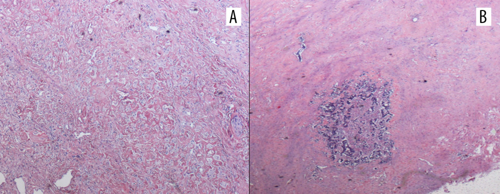Mesenteric fibrosis with mesenteric tumor deposit (MTD). (A) Collagen bundles with associated fibroblasts (hematoxylin and eosin original magnification 100×); (B) MTD with an irregular contour and dense fibrosis with scant chronic inflammation at the periphery (original magnification 20×).