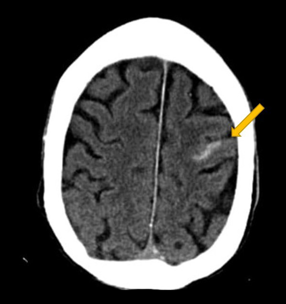 Computed tomography of the head revealed hemorrhage in the mid-left frontal lobe convexity.
