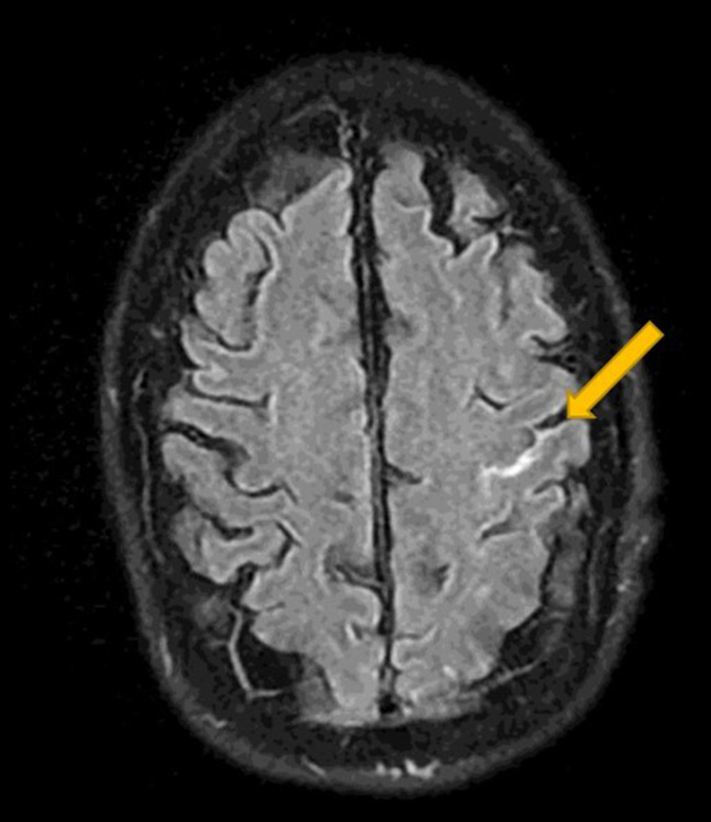 Magnetic resonance imaging on T2 FLAIR (fluid-attenuated inversion recovery) showed a hemorrhage in the left-mid-frontal lobe gyrus.