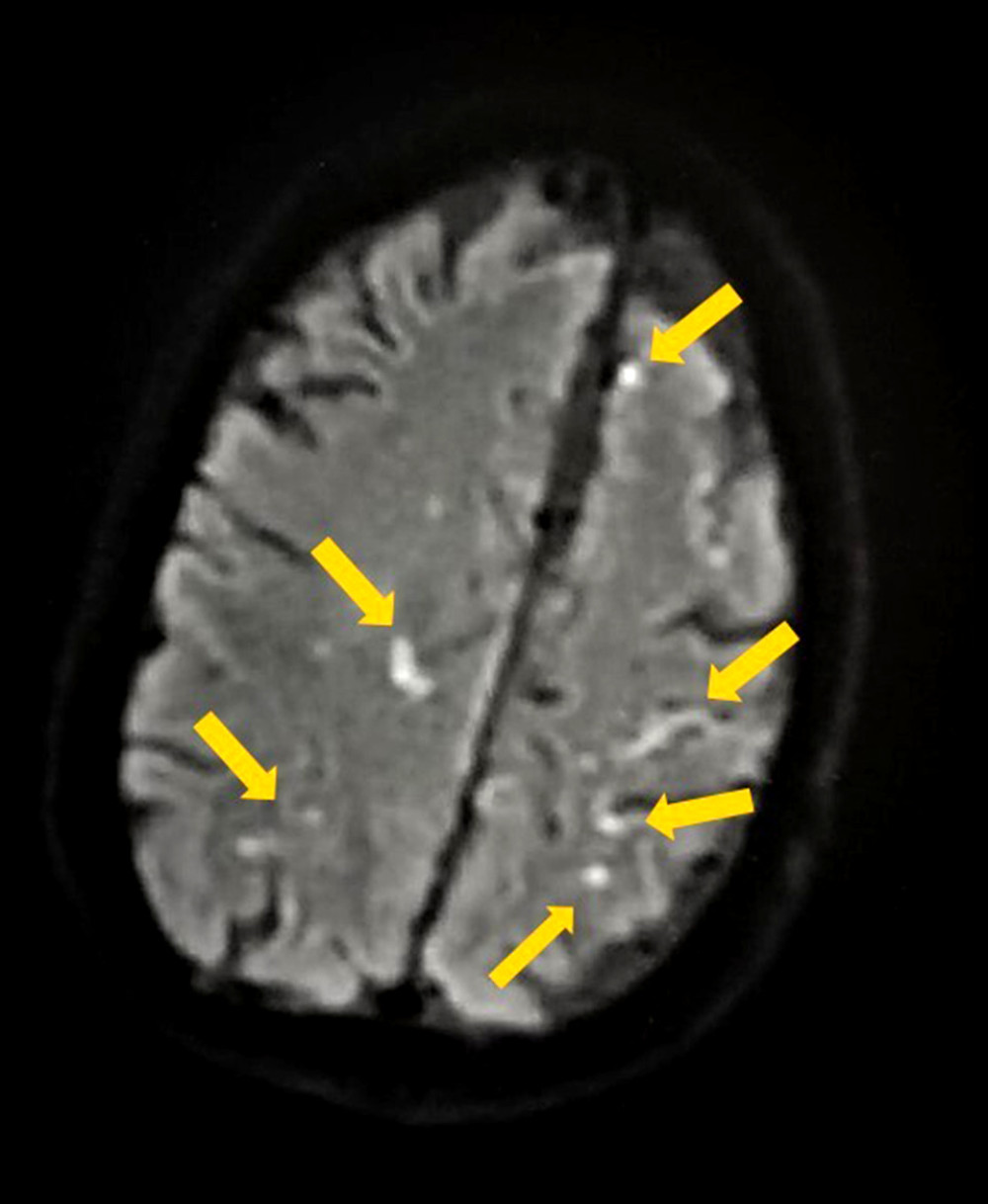 Magnetic resonance imaging on diffusion-weighted imaging showed multifocal bilateral punctate ischemic lesions in both anterior and posterior circulation.