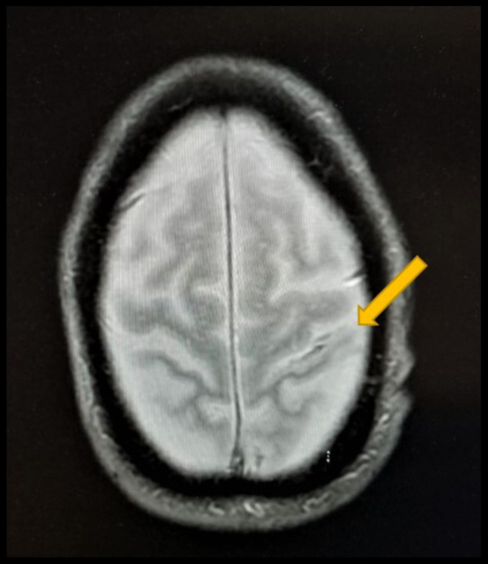 Magnetic resonance imaging with gradient recall echo revealed a convexal hemorrhagic pattern in the mid-left frontal lobe without microhemorrhages and superficial siderosis.