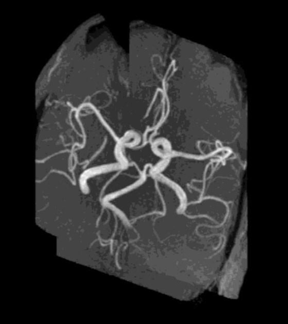 Magnetic resonance angiography did not show the presence of aneurysms or segmental vasoconstriction.