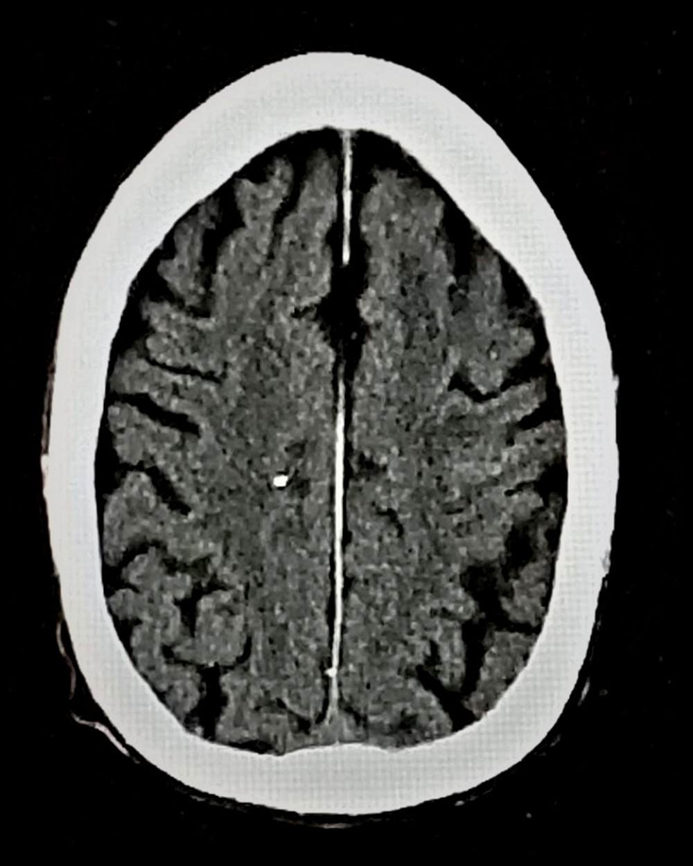 Computed tomography of the head performed 5 days after antibiotic treatment showed regression of the convexal subarachnoid hemorrhage.