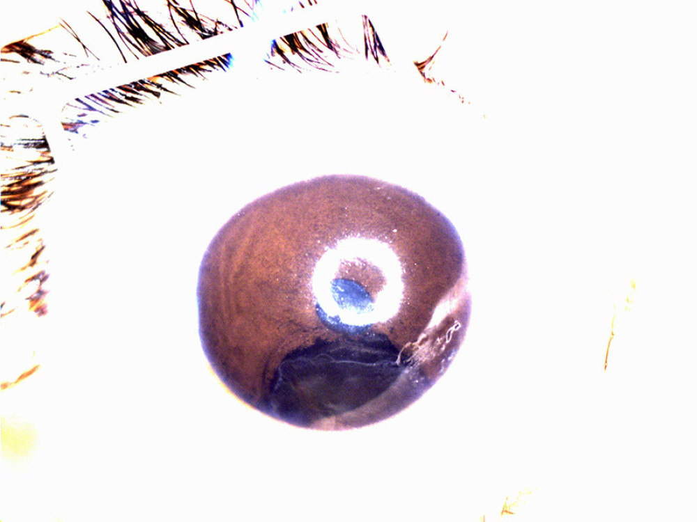 Image of a large, jet-black lesion in the iris in close proximity to the pupillary margin with mild corneal edema atop it.