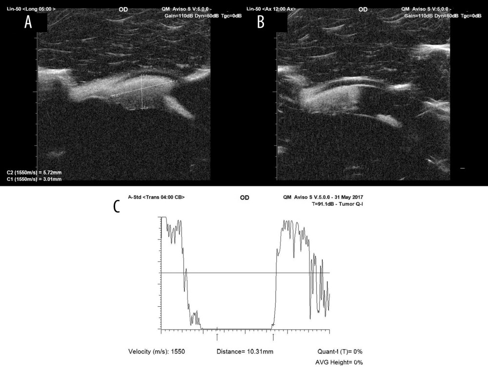 (A) Ultrasound biomicroscopy (UBM) shows a solid iris mass that measures 3.01 mm in depth and 5.72 mm in width with no calcification or ciliary body involvement. (B) UBM showing the attachment between the iris mass and the corneal endothelium. (C) An amplitude scan shows the highly reflective mass.