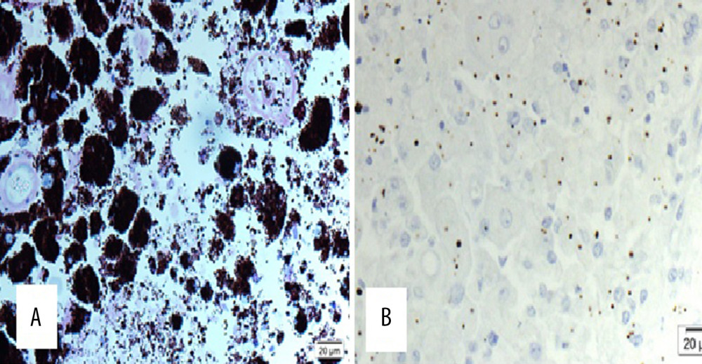 (A) Histology shows that the tissue of the iris is infiltrated by large polyhedral nevus cells with dense pigmentation and obscure cellular details (hematoxylin and eosin 400×). (B) Large bland cells with oval to round nuclei and indistinct nucleoli with abundant cytoplasm, consistent with the diagnosis of melanocytoma (melanin A bleached 400×).