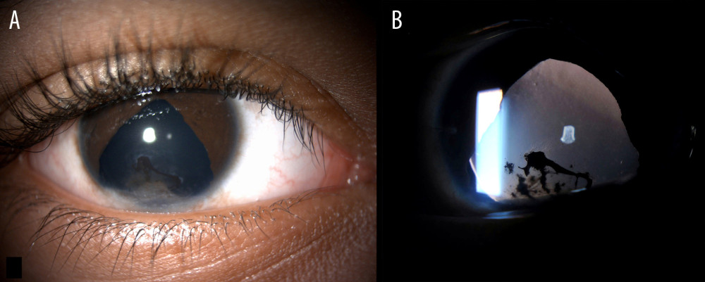 (A) Slit lamp examination after excision shows inferior corneal haze with inferior iris defect and pigmentation of the cornea due to prior adhesion. (B) A retroillumination technique highlights the area of corneal pigmentation.