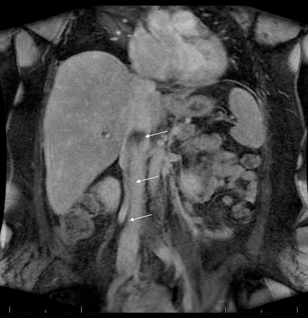 Contrast-enhanced MRI of the abdomen after cardiac mass resection, revealing filling defect in mid- to inferior vena cava, extending up to the level of the liver (arrows).
