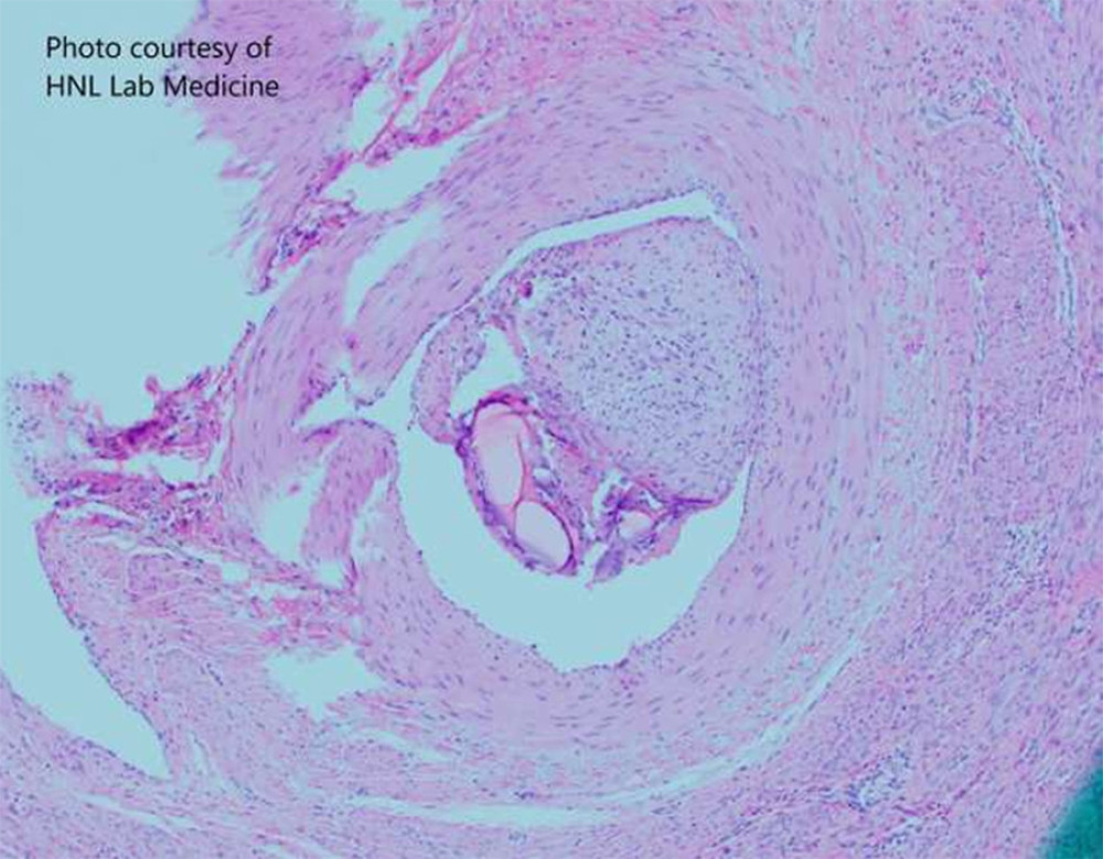 Pathology of right atrial mass, revealing benign leiomyoma.