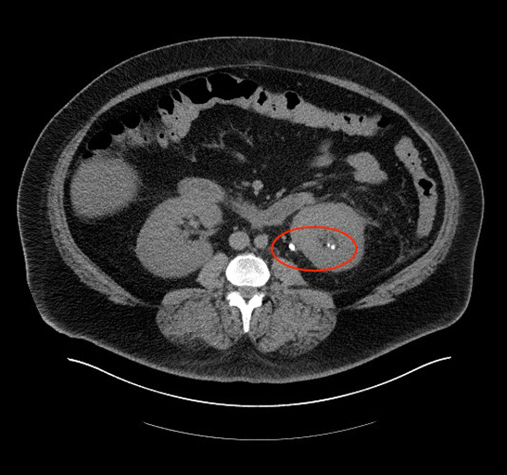 Computed tomography scan of abdomen and pelvis with intravenous contrast axial. Three calcifications (red circle) in the left ureteropelvic junction, with mild left hydronephrosis.