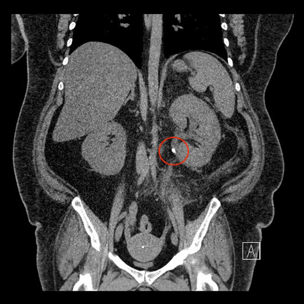 Computed tomography scan of the abdomen and pelvis with intravenous contrast coronal. An obstructing stone (red circle) at the left ureteropelvic junction.