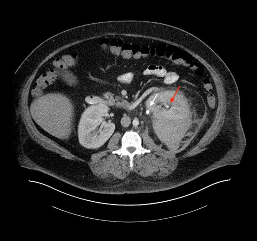 Computed tomography scan of the abdomen and pelvis with intravenous contrast axial. An unchanged perirenal hematoma with consistent pyelonephritis and a left-sided ureteral stent (red arrow), with ureteropelvic junction calculus (white arrow) without change.