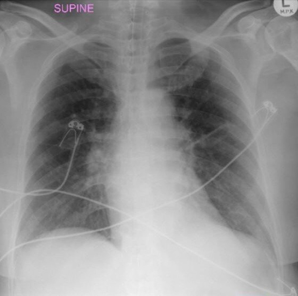 Supine chest X-ray demonstrating bilateral interstitial infiltrates and fluid in the horizontal fissure.