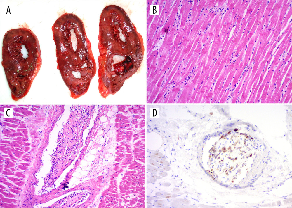 (A) ‘Doughnut’ sections of heart showing tan areas (*) of acute infarction in the left ventricular wall. (B) Loss of left ventricular myocyte nuclei, neutrophilic infiltration, and contraction band necrosis (H&E, ×200). (C) Intramural branch of left coronary artery containing tumor embolus (H&E, ×100). (D) Positive calretinin immunohistochemistry of myxoma cells within tumor embolus (×200).