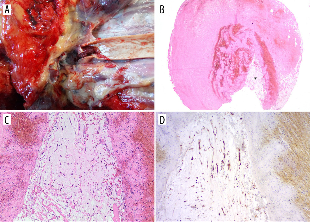 (A) Lateral view of impacted tumor embolus at right common carotid artery bifurcation. (B) Carotid artery tumor fragment (*) with surrounding thrombus (H&E, ×20). (C) Higher magnification of B (H&E, ×100). (D) Calretinin immunohistochemistry highlighting tumor cells (×100).