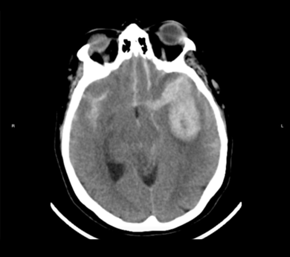 Computed tomography (CT) shows a subarachnoid hemorrhage and left temporal hematoma.