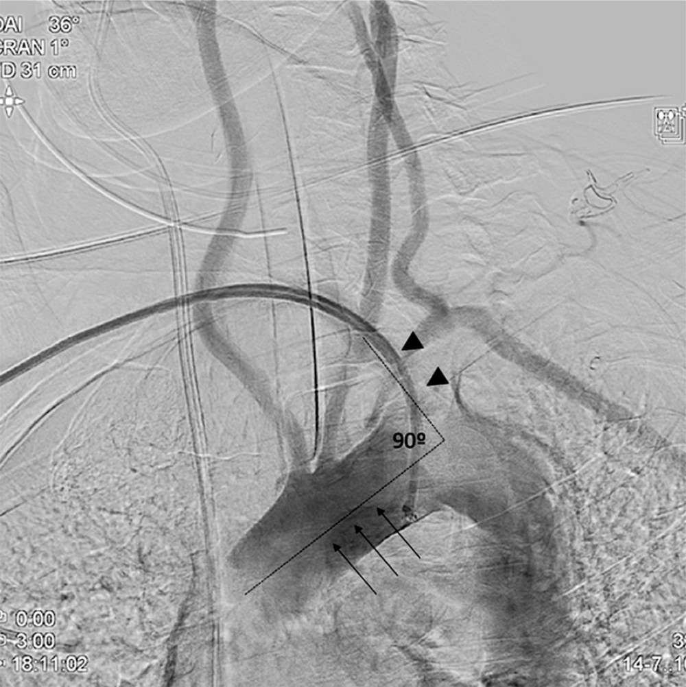 Later aortogram. Dotted lines mark a 90° angle between the right subclavian artery and aortic arc. Arrowheads indicate subclavian artery direction and black arrows show aortic arc direction.