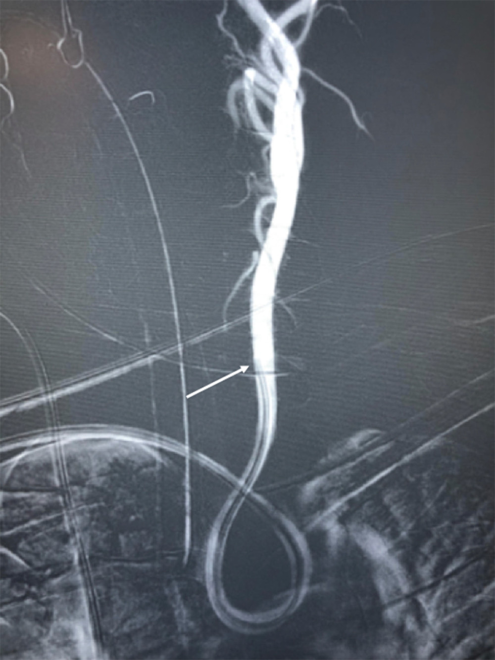 A complete curved Simmons catheter is located in the left carotid artery during angiography. White arrow shows distal tip of Simmons catheter in common left carotid artery.