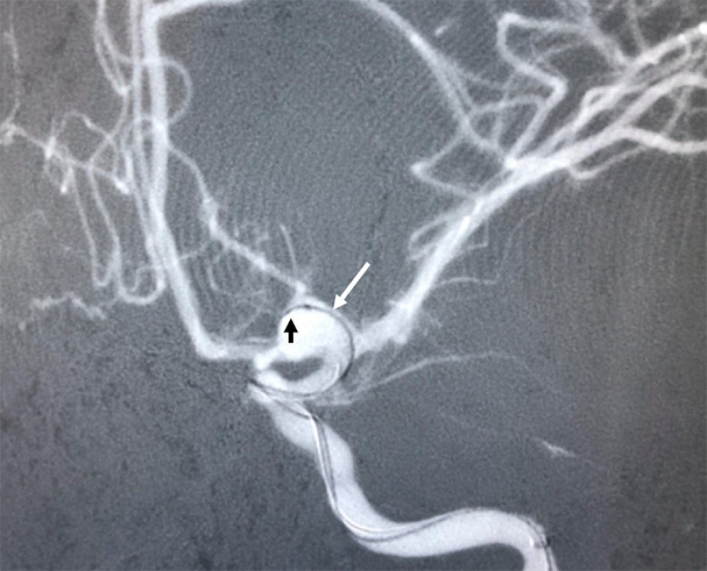 Oblique anteroposterior angiography shows the microcatheter inside the aneurysm (white arrow) and the first coil entering it (black arrow).