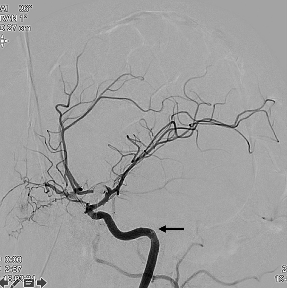 Oblique anteroposterior angiography shows the aneurysm occluded. Black arrow indicates the tip of the intracranial support catheter within the carotid artery’s petrous segment.