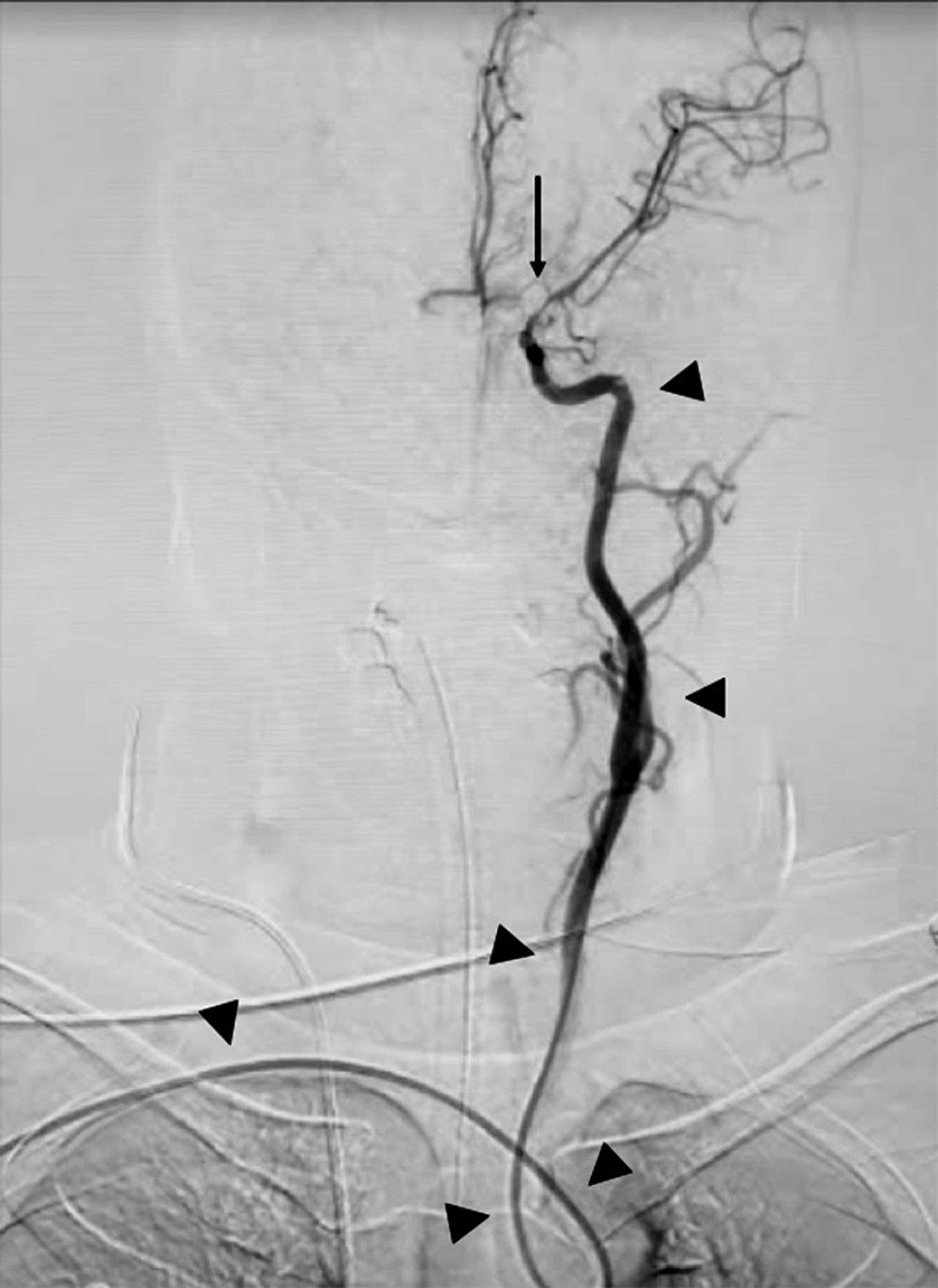 Final anteroposterior angiography shows the trajectory of the intracranial support catheter (arrowheads) and the aneurysm occluded (arrow).