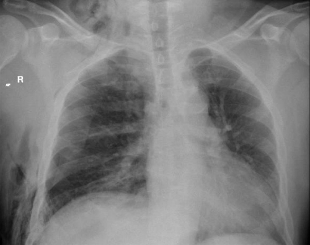 Initial chest X-ray following patient admission to the Emergency Department. Anteroposterior chest X-ray at admission showing a small right pneumothorax. Associated ill-defined opacities in the right lung base consistent with pulmonary contusions are seen. There is also abundant subcutaneous emphysema along the lateral chest wall of the right hemithorax, with underlying multiple rib fractures. No definite evidence of intercostal lung herniation is apparent.