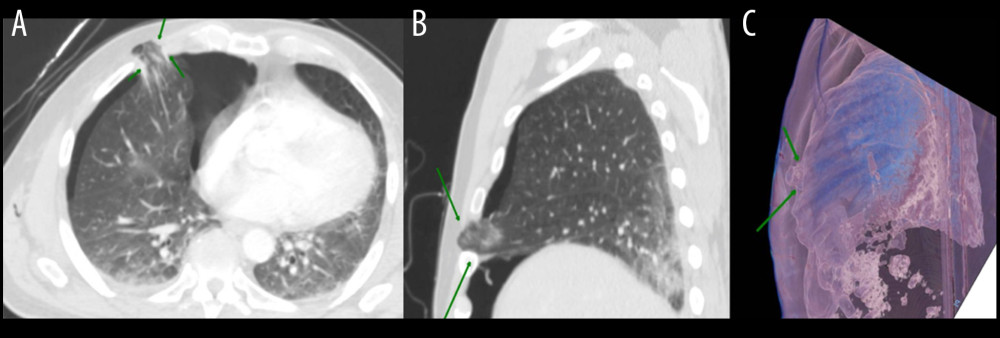 Follow-up chest computed tomography (CT) scan performed in the Emergency Department: (A) contrast-enhanced chest CT performed the day of admission showing a moderate right pneumothorax with a concomitant anterior chest wall defect through which a portion of the right middle lobe is herniating (arrows); (B, C) sagittal and 3-dimensional reconstruction showing the same anterior wall defect and consequent intercostal hernia of the right middle lobe (arrows).