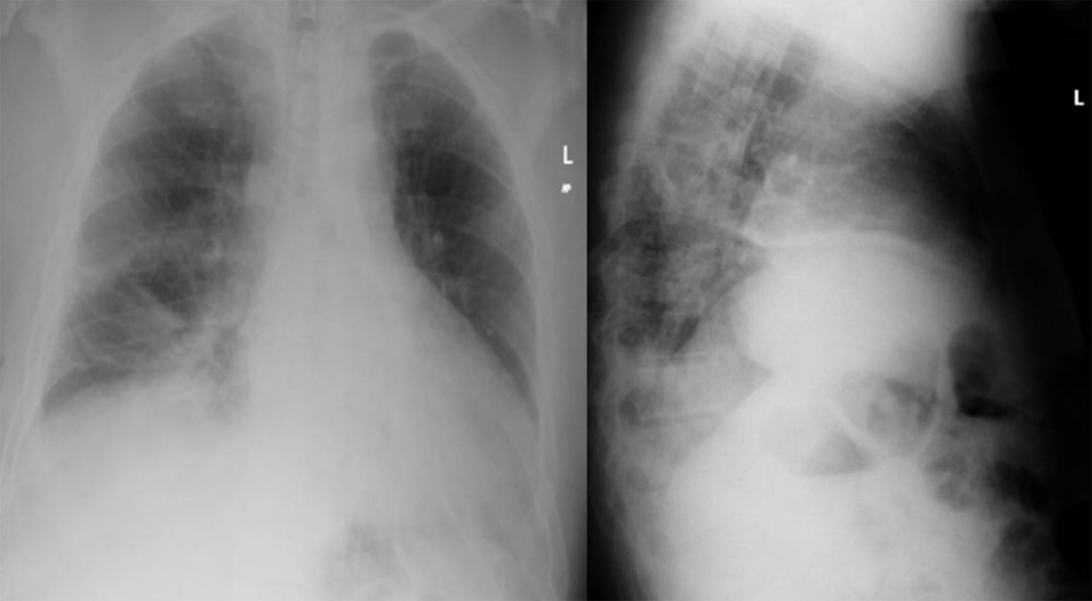Chest X-rays performed on the day of discharge after clinical improvement. Posteroanterior and lateral chest X-ray performed the day of discharge showing resolution of the right pneumothorax. Additionally, the resolution of the previously observed subcutaneous emphysema is noted. Streaky right lower lung subsegmental atelectatic strands are also noted.