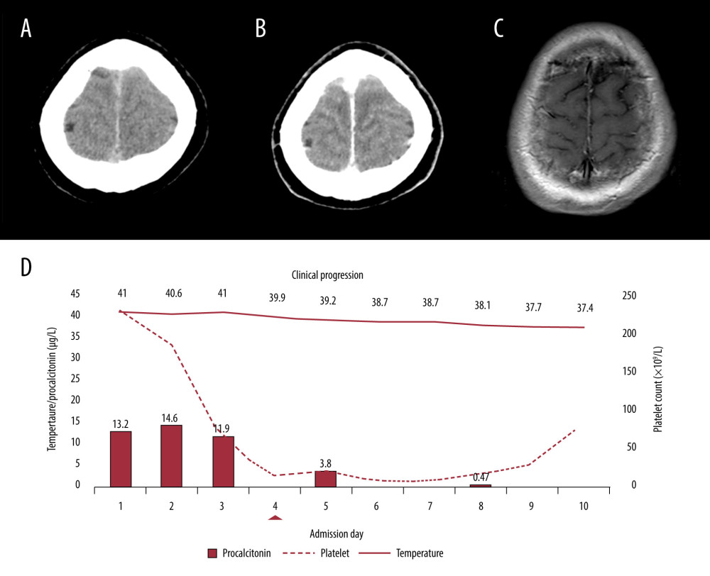 (A) Brain computed tomography (CT) without contrast showing crowded cerebral gyri and sulcal effacement and (B) brain CT with contrast showing leptomeningeal enhancement. (C) Brain magnetic resonance imaging on day 9 of admission showing resolution of cerebral edema and leptomeningeal enhancement. (D) Clinical progression of the patient showing the increase in platelets following defervescence, the resolution of delirium (arrowhead), and the procalcitonin trend.