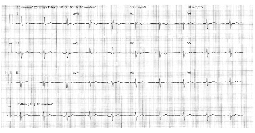 Baseline ECG. Baseline ECG shows sinus rhythm with nonspecific repolarization abnormalities in the form of T wave inversion in leads V1–V3 with no features suggestive of type 1 Brugada syndrome.
